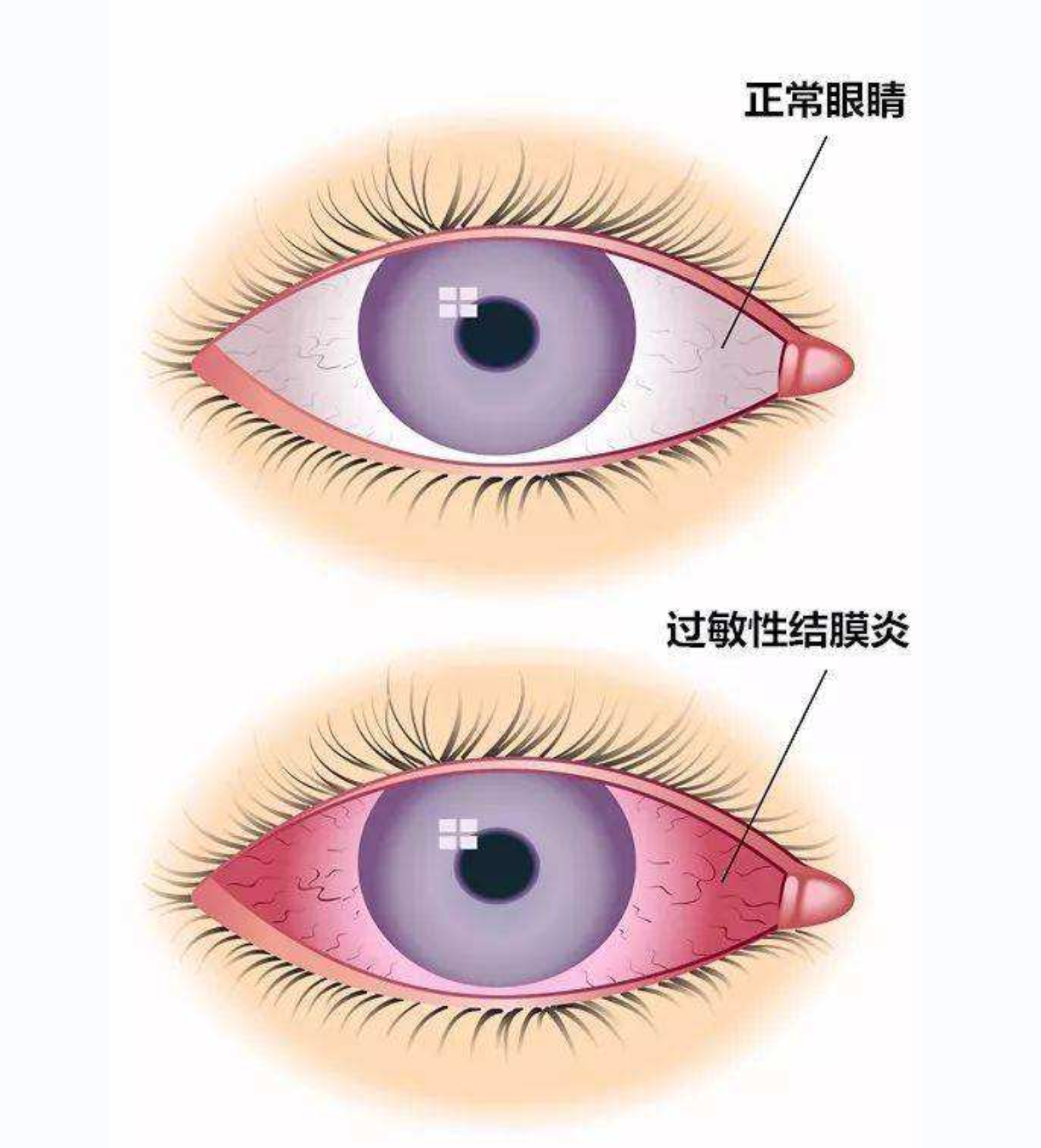 眼痒流泪眼白发红出现这3种情况警惕过敏性结膜炎过敏性结膜炎又称为