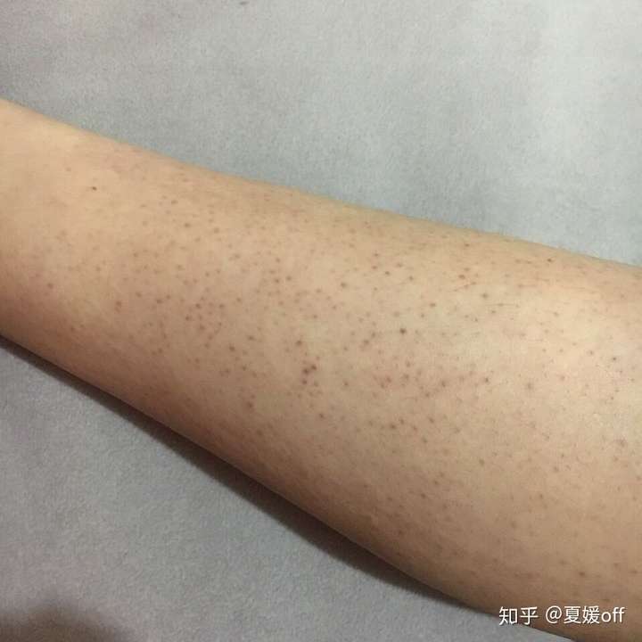 鸡皮肤怎么治疗知乎(去鸡皮肤最有效的方法知乎)