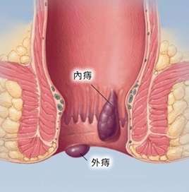 肛瘘和痔疮的区别图片