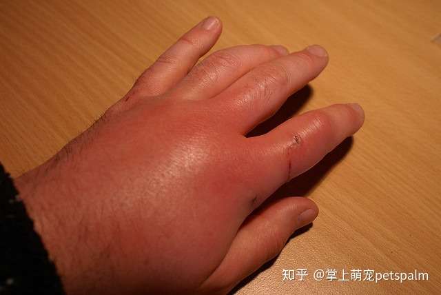 如何治疗猫叮咬和猫叮咬感染