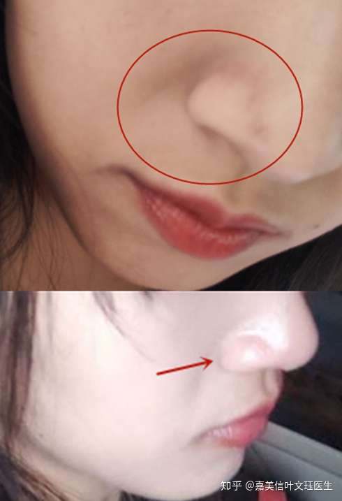 这样的法令纹是鼻基底过低导致的嘛?