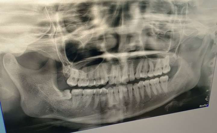 全口牙槽骨吸收?