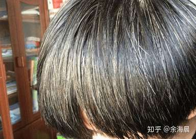 不仅秃了还有白发的90后 如何是好 知乎
