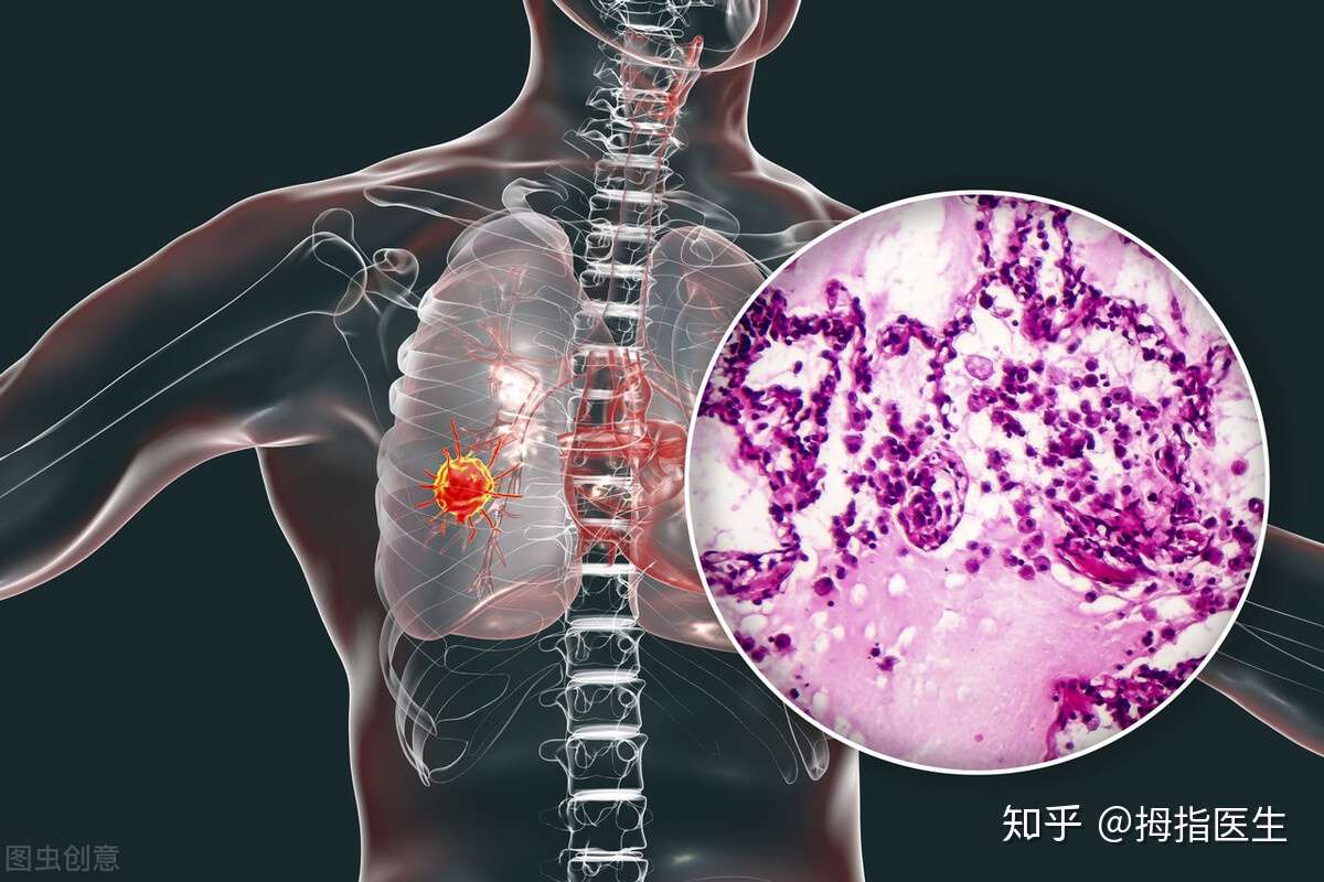 肺癌可以治愈吗 医生说 主要看类型和治疗方案 知乎 肺癌可以治愈吗 医生说 主要看类型和治疗方案 知乎