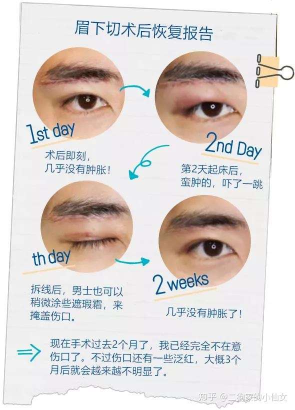 真实日记 年轻5岁的提眉术体验 眉下切 知乎