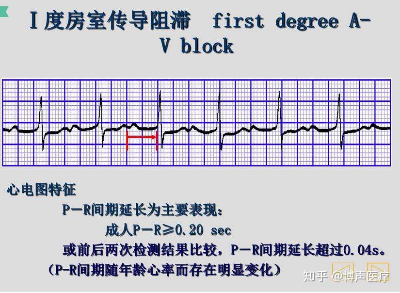 博声医疗 房室传导阻滞 I度房室传导阻滞 知乎