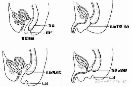 肛门闭锁常见问题解答 下 小儿外科专家王勇科普系列 知乎