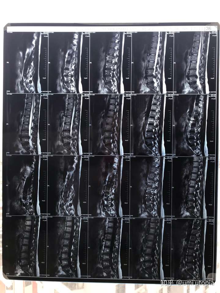 27歲,腰椎間盤l5s1突出壓迫右側神經,附核磁共振,到要手術的程度了嗎?