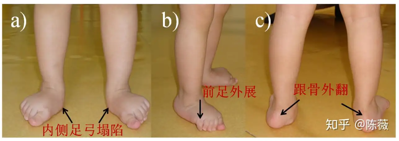 矫形鞋垫对儿童足外翻畸形矫治的生物力学分析 知乎