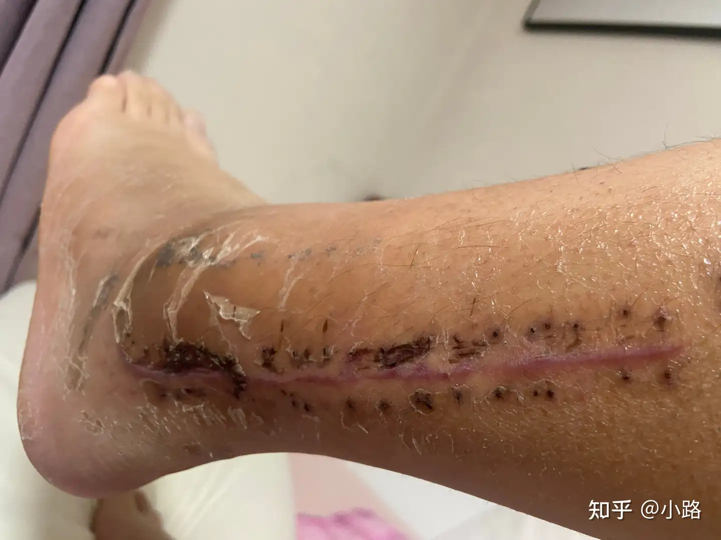 踝骨骨折及胫骨骨折 手术后第四十天恢复情况 知乎