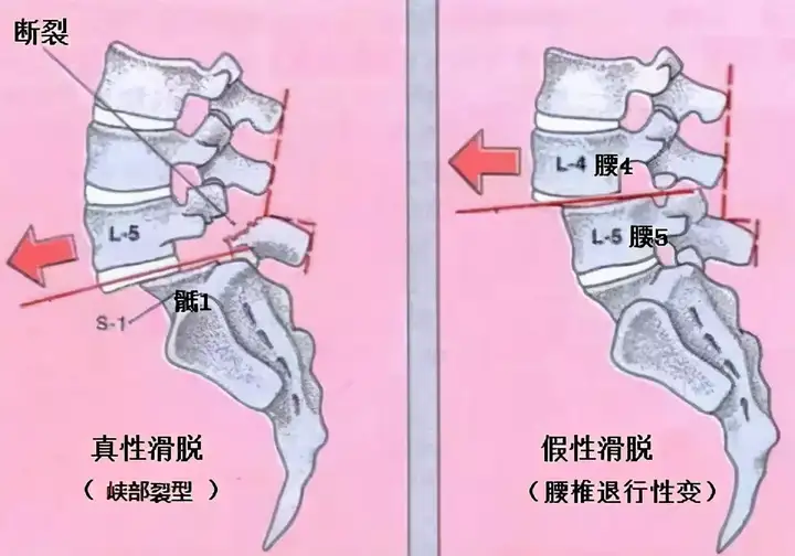 腰5椎体1度滑脱严重吗?腰椎滑脱日常需要注意什么?插图 腰5椎体1度滑脱严重吗?腰椎滑脱日常需要注意什么?插图
