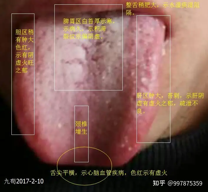 望闻问切，阴虚阳虚气虚血虚上火用要辩证舌头治疗- 知乎