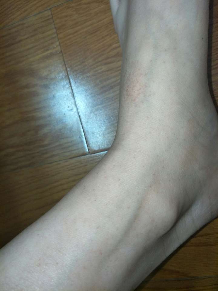 请问有大神知道腿上有血点小红点这是怎么回事吗