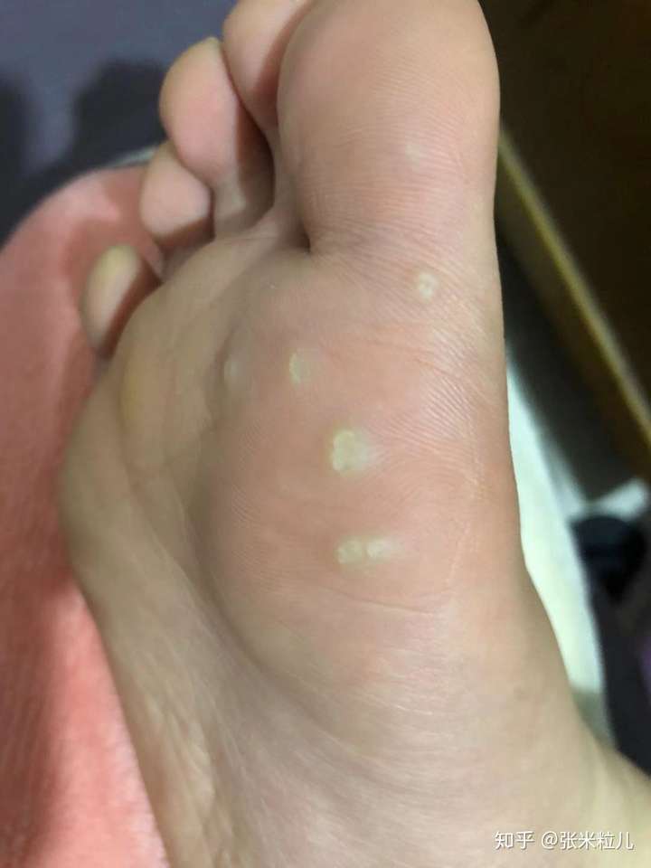 跖疣自愈经验分享