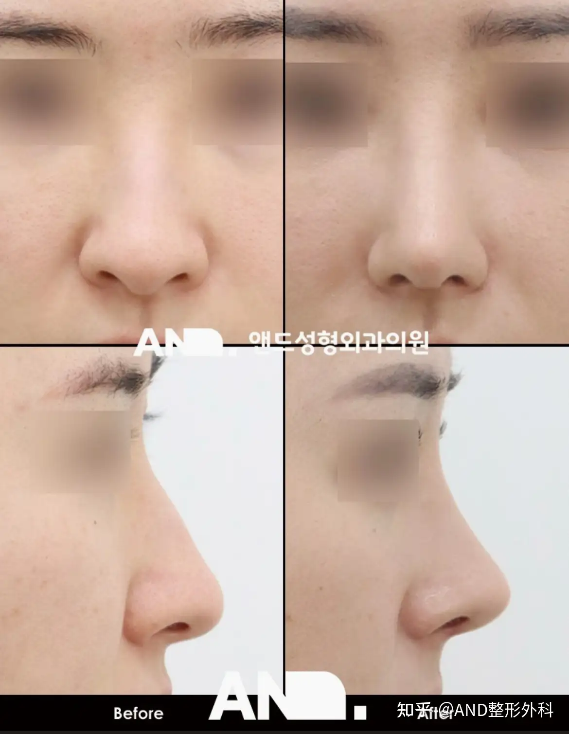 鹰钩鼻手术和龙鼻矫正同时解决的方法[鼻部整形(鼻梁+鼻尖+鼻翼下降+ 