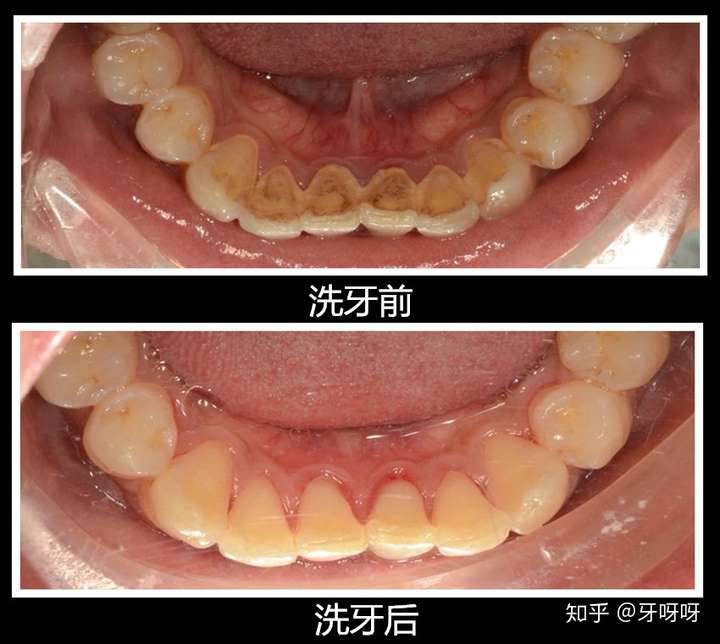 抽烟嚼槟榔的人洗牙完后是什么感觉