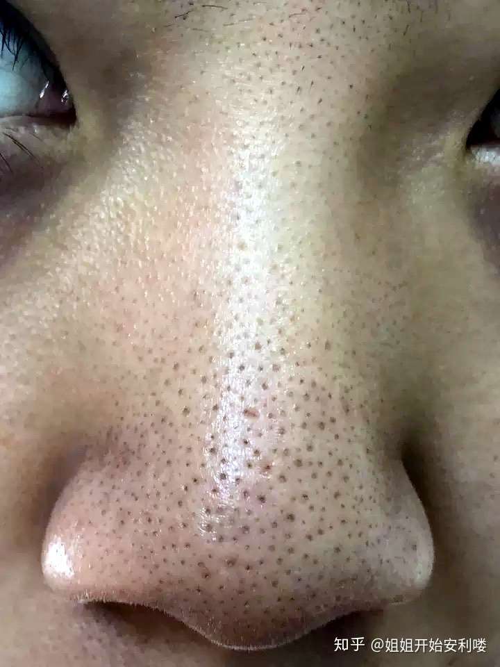 你见过最大的黑头有多大?