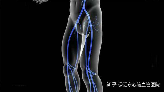 下肢动脉硬化闭塞症有以下几种情况要小心了