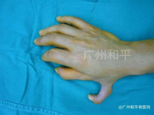 广州和平骨科医院 的想法: 成年人多指 |  a class="hash_tag" href="