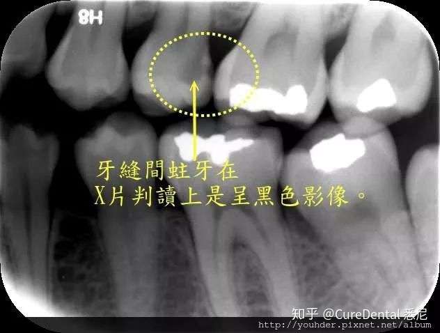 悉尼牙医爱拍x Ray 究竟是为什么 知乎