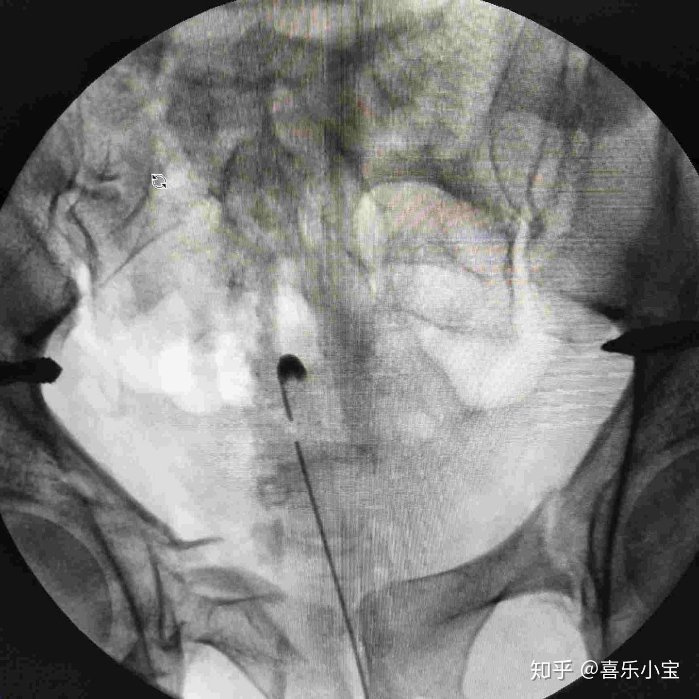 治疗陈旧性骨盆骨折临汾市中心医院实施微创手术 知乎