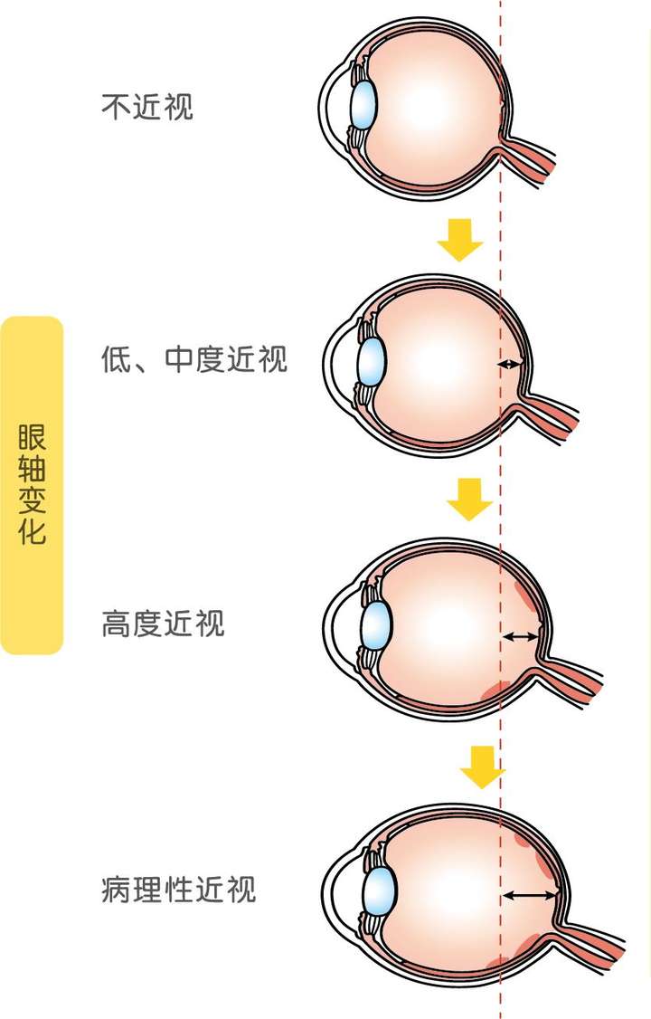 絕大部分高度近視都是由於眼軸過長導致的.