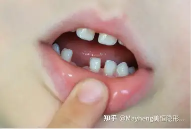 刪從牙齒大小和磨損程度上也能區分,恆牙牙冠會比相對的乳牙牙冠要大