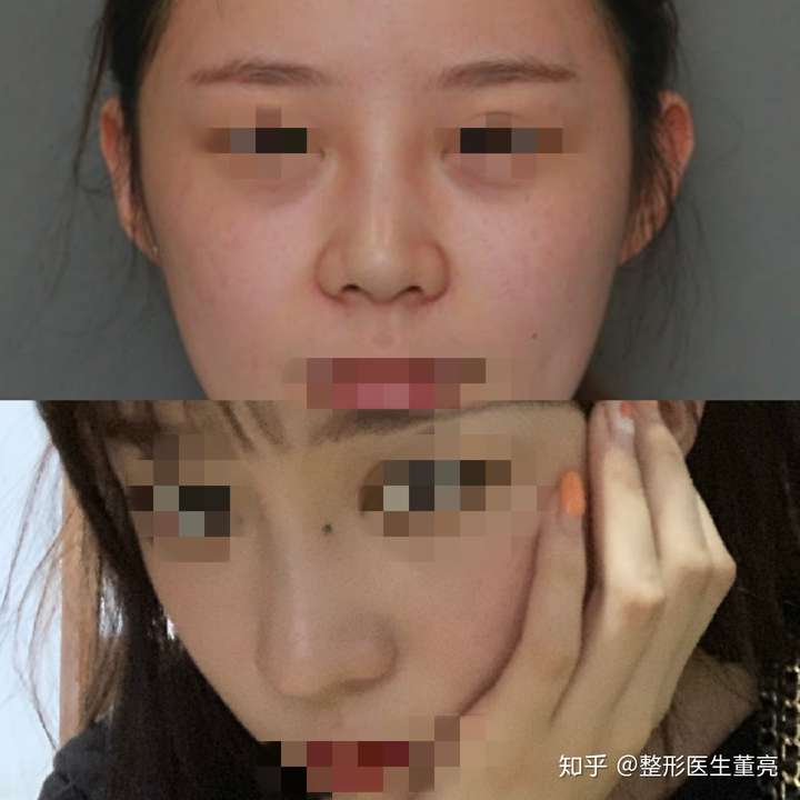 塌了20年的鼻子有什么建议吗?