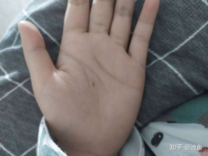 两个手都有,左手掌心痣是从出生就有的,右手是后天长出来的,别人都说
