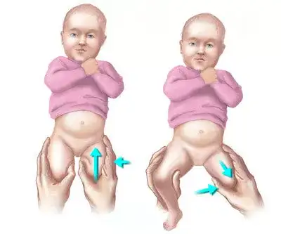 婴儿腿纹不对称图片