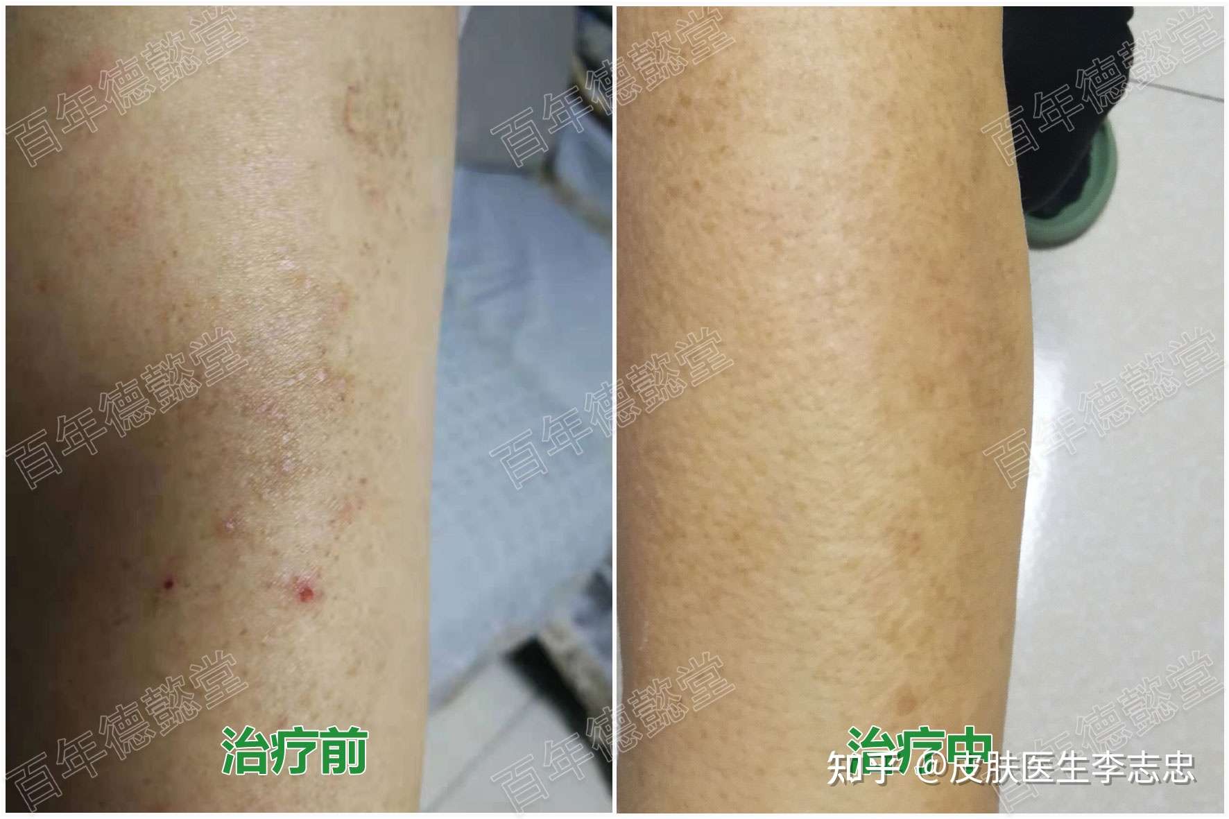 皮膚醫生李志忠 的想法: 皮膚澱粉樣變,吸收比較快,用藥還不到一