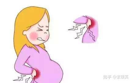 怀孕坐骨神经痛图片