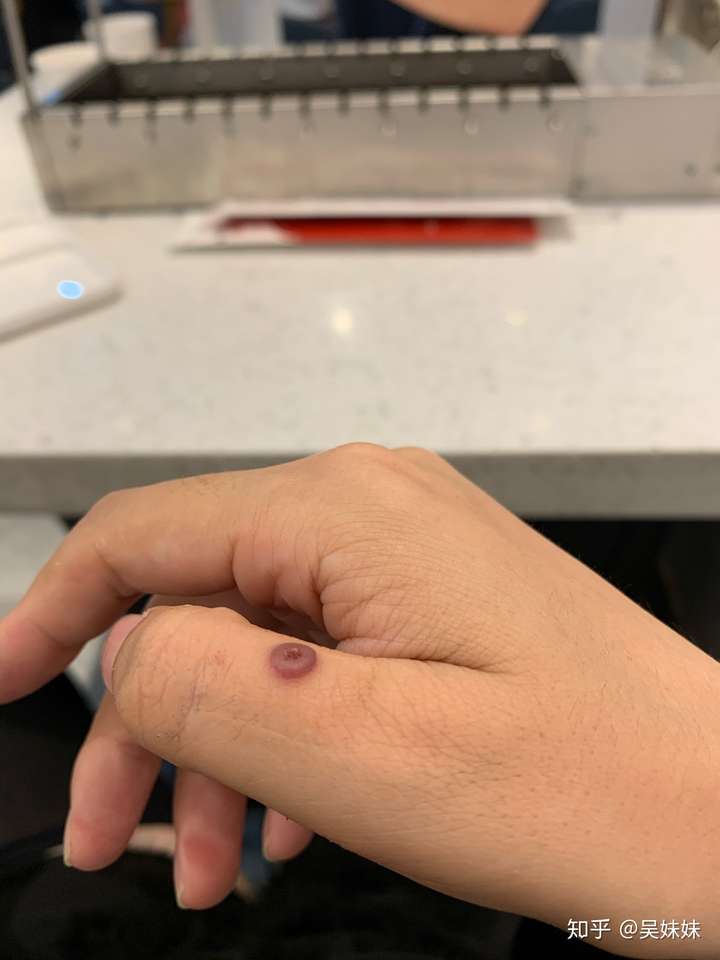 甲下寻常疣做液氮冷冻疼哭了,可耐受疼痛真的这么厉害吗?