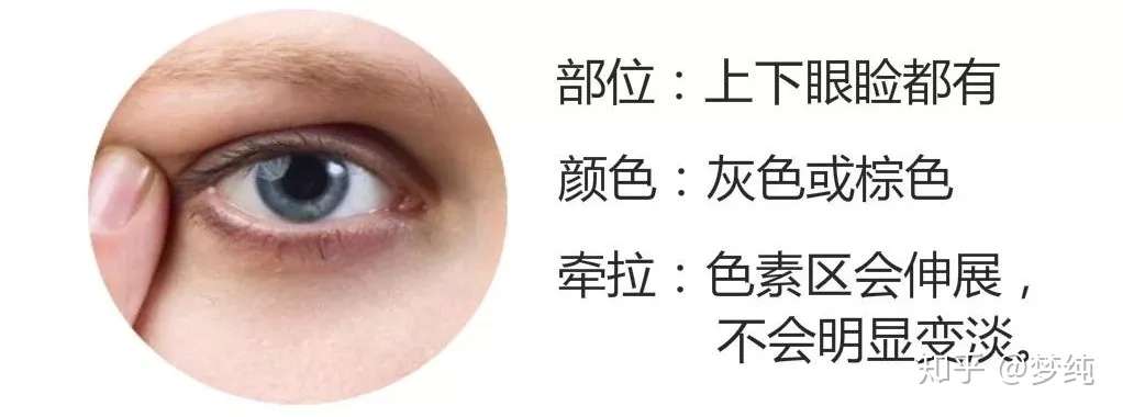 黑眼圈是怎样炼成的 知乎 黑眼圈是怎样炼成的 知乎