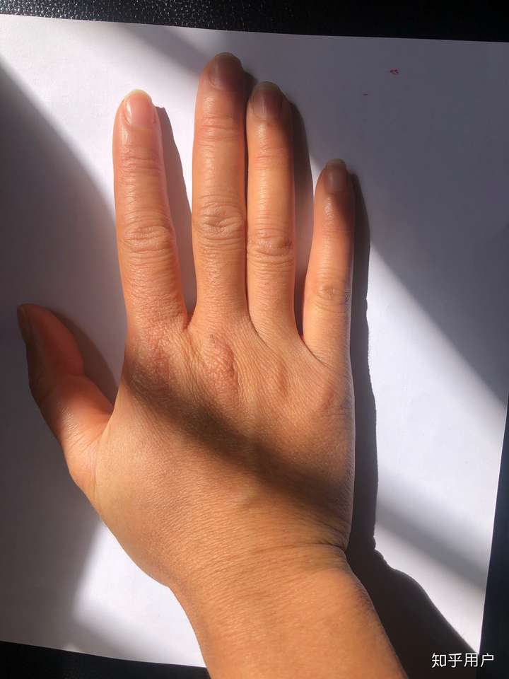 我是女生,手背上汗毛很多,毛孔特别大,密密麻麻的,大家有紧毛孔的办法