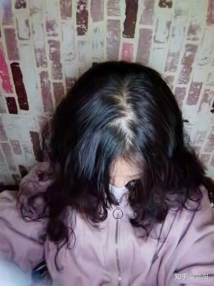 为什么我发量挺多的但是就头顶刘海的分界线那里感觉很秃