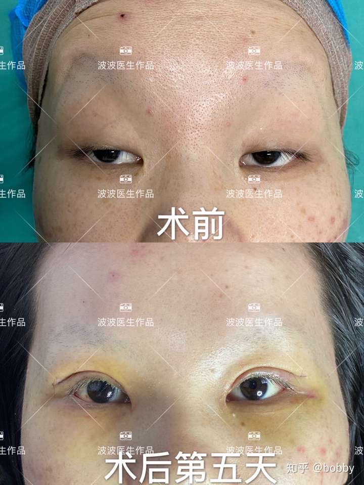 重度上睑下垂肌力为0的患者手术对比