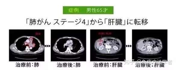 癌症治疗一物克一物 实体瘤的 苦主 终于找到了 知乎