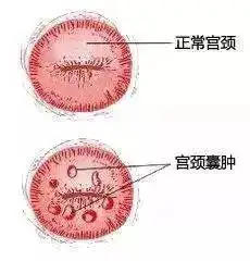 宫颈囊肿需要治疗吗? - 知乎