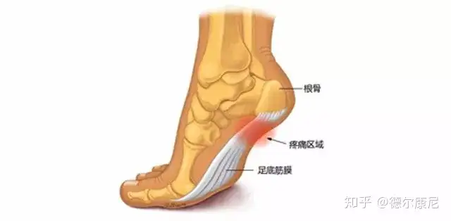 脚疼是怎么回事 不同位置疼痛的原因不同 这篇文章都说全了 知乎