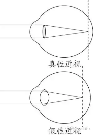 青少年近視防控之孩子為什麼會近視中