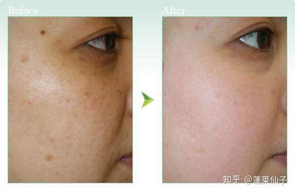 市场总监 皮肤问题之脾斑 1,脾斑成因 脾气不足,肝郁乘脾,导致脾虚