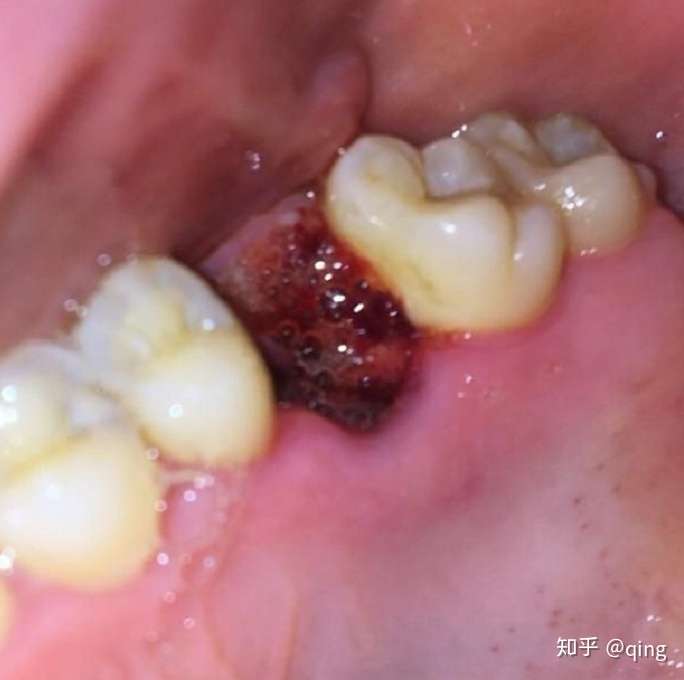 關注問題 67 寫回答 智齒 牙科 拔牙 拔除智齒 阻生智齒 撥過智葺