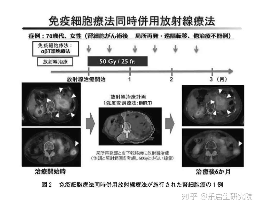 免疫放疗的联合疗法将成为全身抗癌的最新利器 对哪些患者效果好 知乎