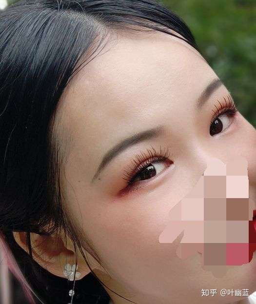 肿眼泡千万别去割双眼皮 不过是换了一种丑法 15个半月啦 知乎