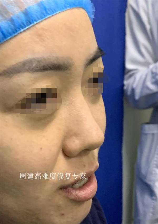 周建医生 鼻梁歪了是怎么办 歪鼻如何矫正 知乎