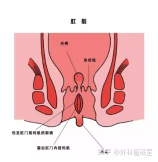 各类肛门疾病图示图片