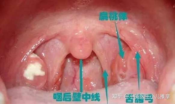 醫生說孩子扁桃體發炎抗生素治療至少10天考慮再三來到小美醫生濟南