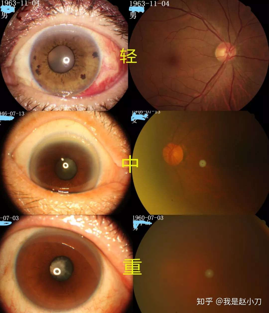 如何判断自己的白内障是在什么程度 该不该手术 白内障是怎么分期的 知乎