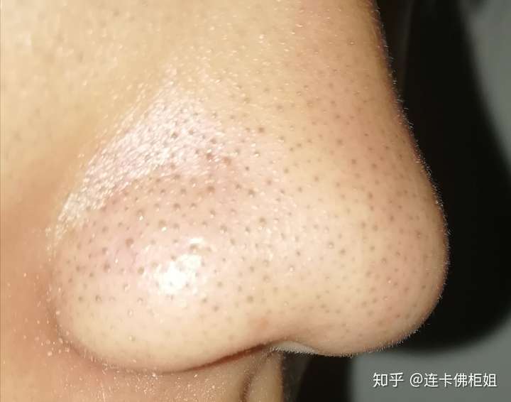 我這種是黑頭嗎,這種皮膚怎麼辦?